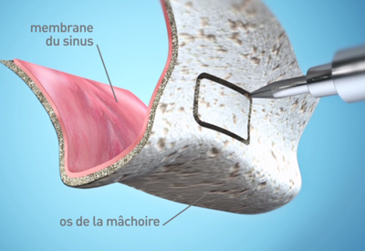 L-analyse-pre-implantaire-Dentiste Montélimar