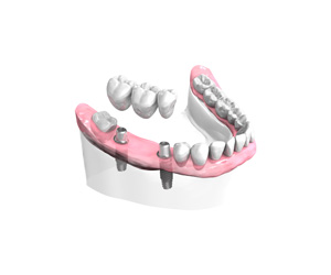 Pose-d-un-bridge-ceramique-sur-implants dentiste Montélimar