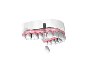 Pose d'une couronne dentaire sur implant Dentiste Montélimar