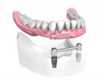 Appareil complet-sur-2-implants-dentaires Dentiste Montélimar