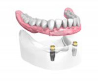 Appareil complet sur 2 implants dentaires et 2 boutons Dentiste Montélimar