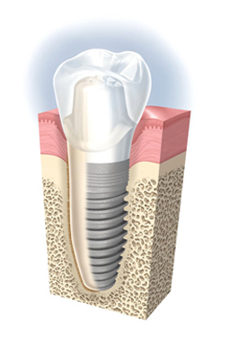 Implant Dentaire Dentiste Montélimar